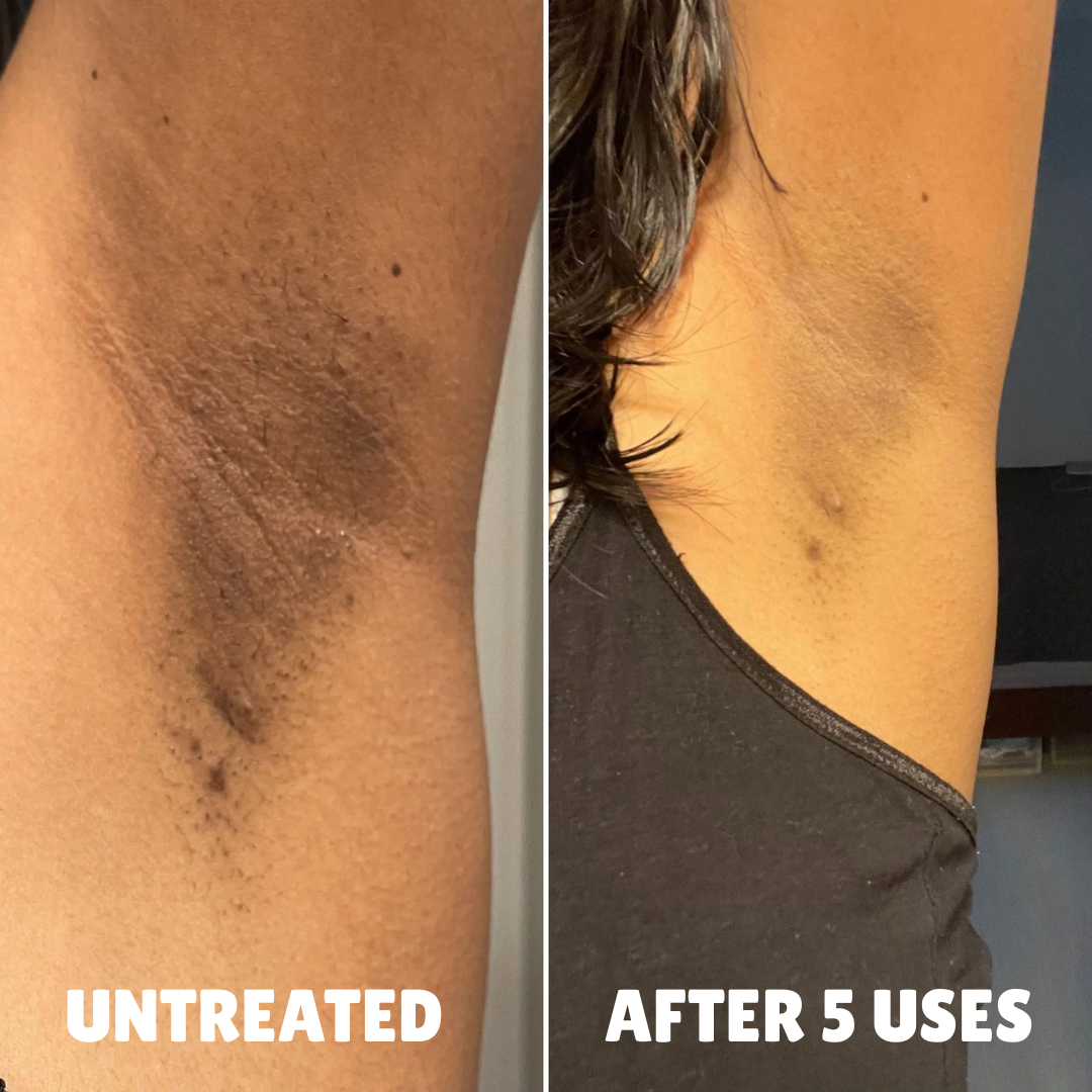 Advanced Triple-Acid Complex for Hyperpigmentation, showing skin improvement after 5 uses.