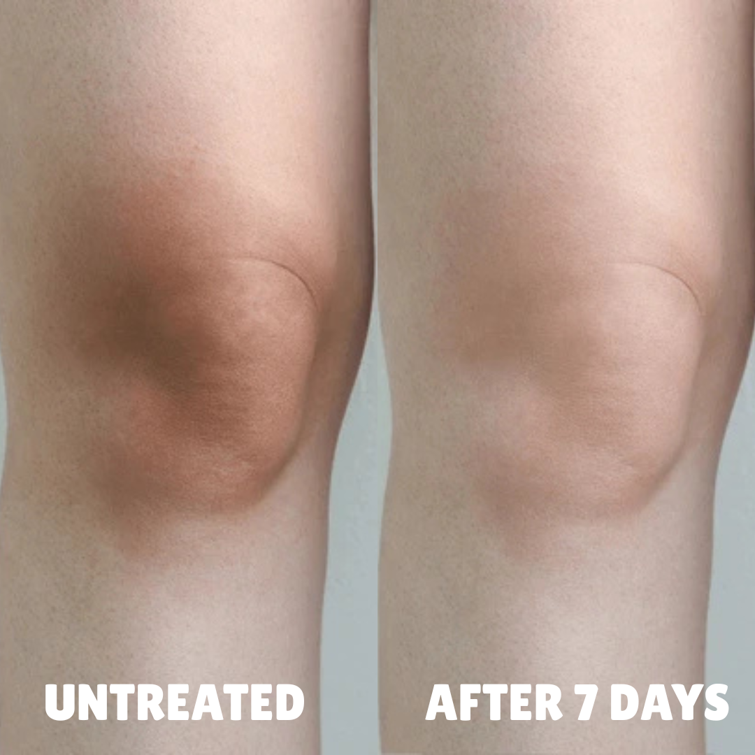 Advanced Triple-Acid Complex for Hyperpigmentation, showing skin improvement after 7 days on knees.