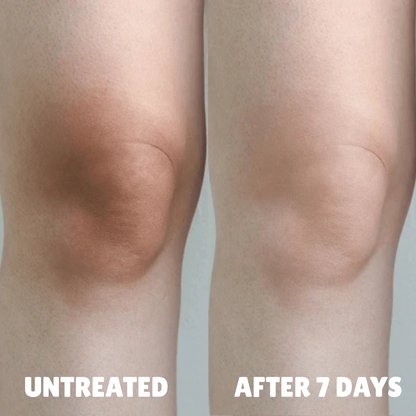Advanced Triple-Acid Complex for Hyperpigmentation, showing skin improvement after 7 days on knees.