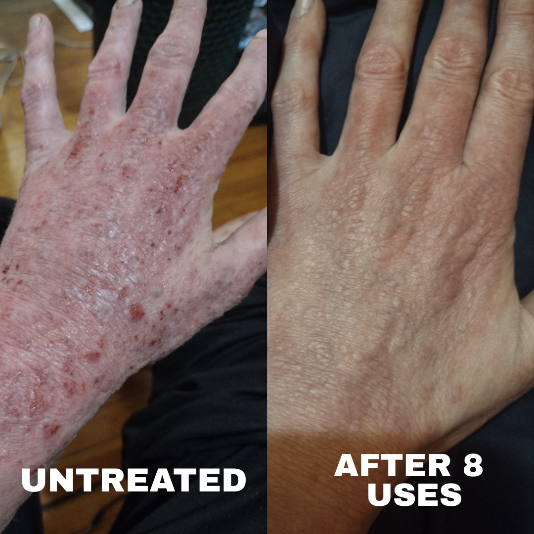 Advanced Barrier Repair Complex for Eczema, showing untreated hand on left and improved condition after 8 uses on right.