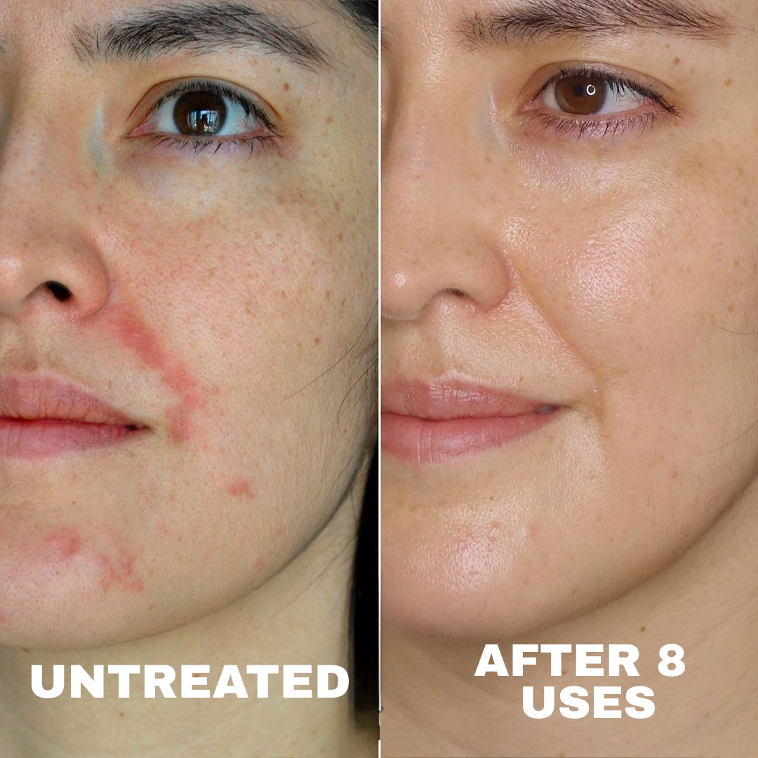 Advanced Barrier Repair Complex for Eczema, showing skin improvement after 8 uses.