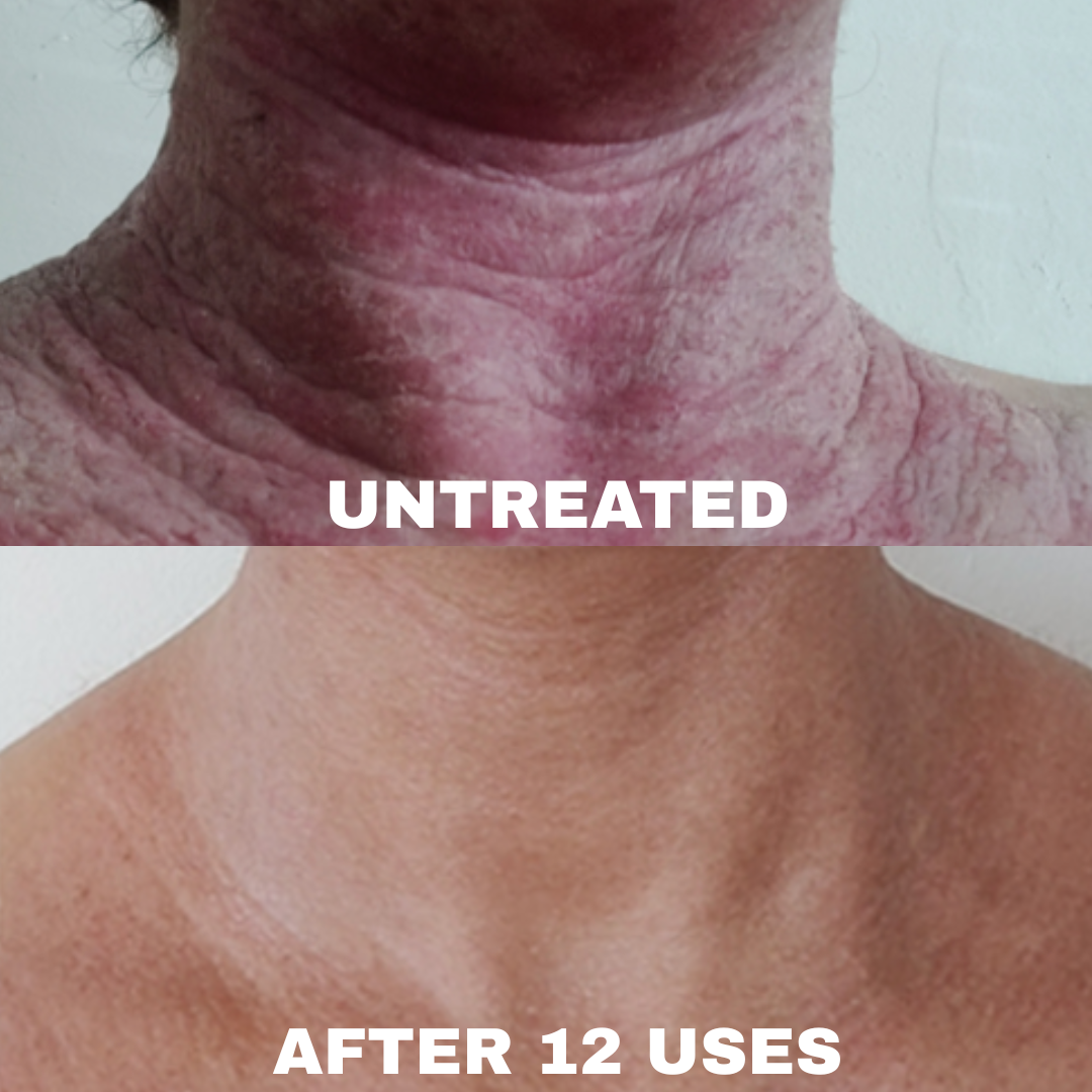 Advanced Barrier Repair Complex for Eczema, showing skin improvement after 12 uses.