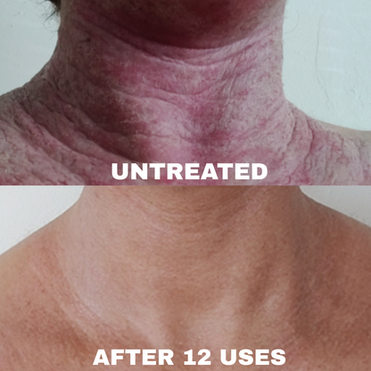 Advanced Barrier Repair Complex for Eczema, showing skin improvement after 12 uses.