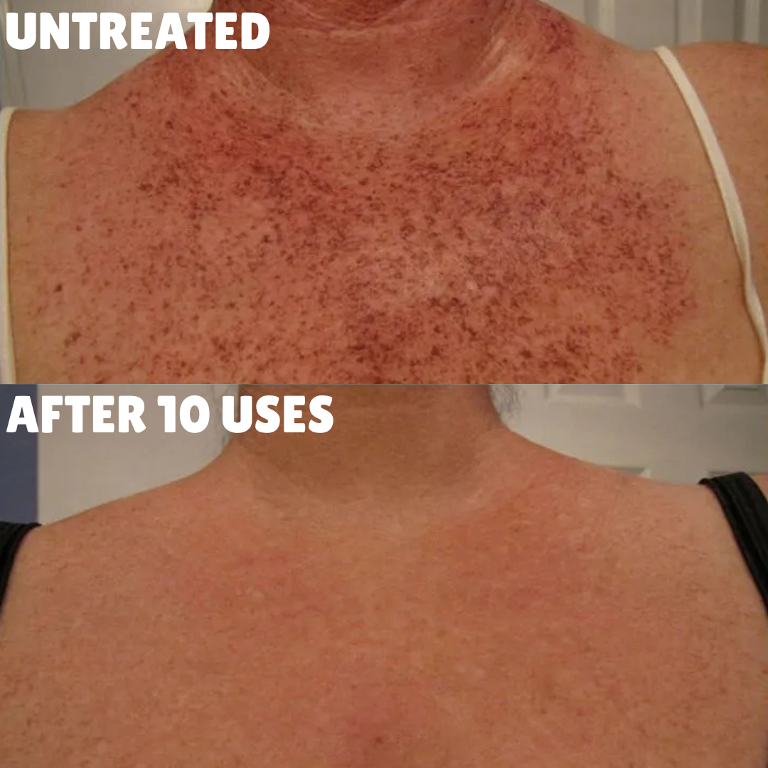 Advanced Triple-Acid Complex for Hyperpigmentation, showing skin before and after 10 uses.