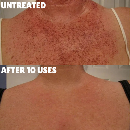 Advanced Triple-Acid Complex for Hyperpigmentation, showing skin before and after 10 uses.