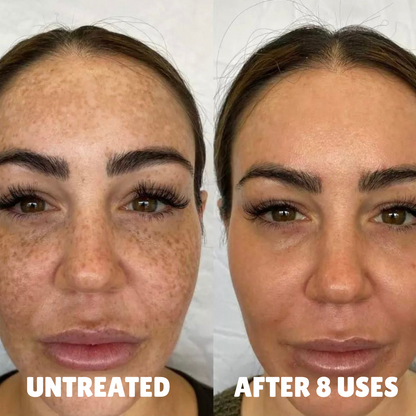 Advanced Triple-Acid Complex for Hyperpigmentation, showing skin improvement after 8 uses.