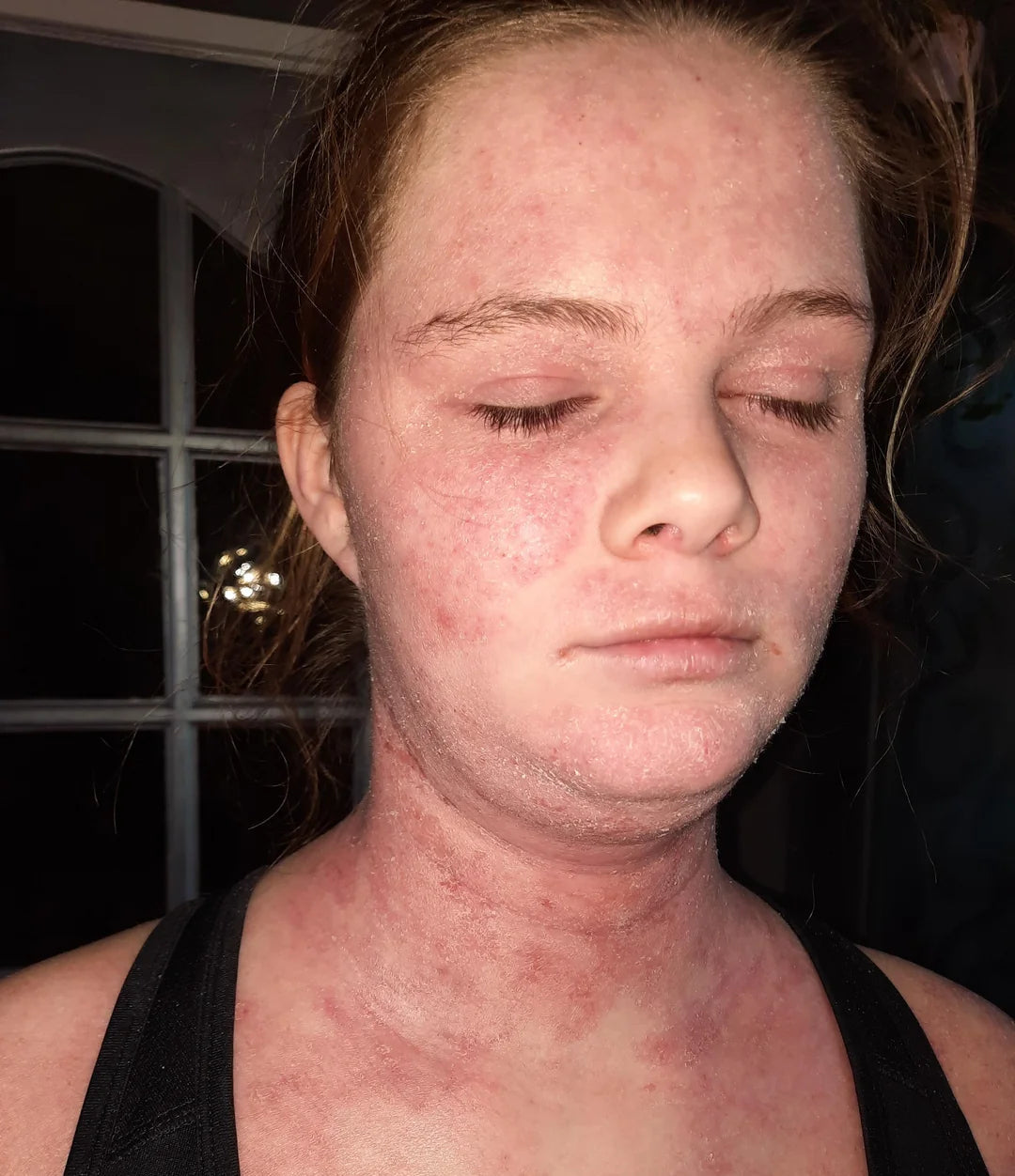 Close-up of a person with visible skin conditions, possibly sun damage or acne scars, against a dark background.
